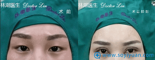 林潮医生第三位切开重睑+上睑去脂+开内眼角真人案例 林潮医生第三位切开重睑+上睑去脂+开内眼角真人案例