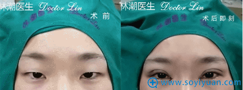 林潮医生三点微创法+开内眼角真人案例 林潮医生三点微创法+开内眼角真人案例