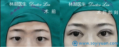 林潮医生第三位三点微创法+开内眼角真人案例 林潮医生第三位三点微创法+开内眼角真人案例