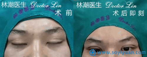 林潮医生双眼皮手术失败修复真人案例 林潮医生双眼皮手术失败修复真人案例
