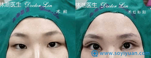 林潮医生第二位切开重睑+上睑去脂+开内眼角真人案例 林潮医生第二位切开重睑+上睑去脂+开内眼角真人案例