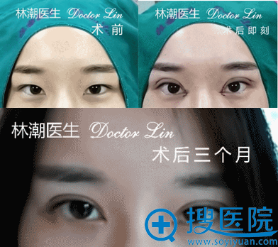 林潮医生切开重睑+上睑去脂+开内眼角真人案例 林潮医生切开重睑+上睑去脂+开内眼角真人案例
