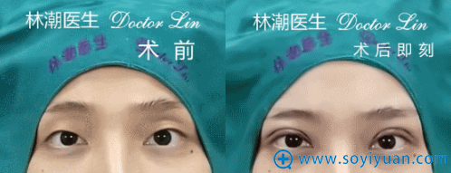 林潮医生第二位双眼皮手术失败修复真人案例 林潮医生第二位双眼皮手术失败修复真人案例