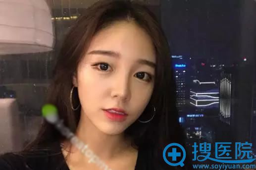 双眼皮手术之前照片 双眼皮手术之前照片