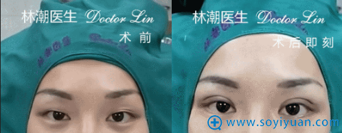 林潮医生第二位三点微创重睑+上睑去脂真人案例 林潮医生第二位三点微创重睑+上睑去脂真人案例