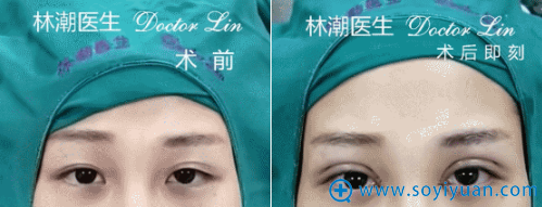 林潮医生第四位三点微创法+开内眼角真人案例 林潮医生第四位三点微创法+开内眼角真人案例