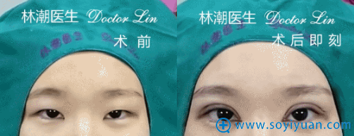 林潮医生第六位切开重睑+上睑祛脂真人案例 林潮医生第六位切开重睑+上睑祛脂真人案例