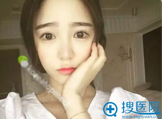 双眼皮整形术后各种自拍照片 双眼皮整形术后各种自拍照片