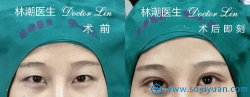 林潮医生第三位切开重睑+上睑祛脂真人案例 林潮医生第三位切开重睑+上睑祛脂真人案例