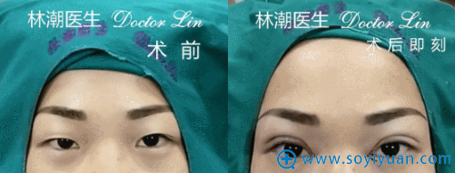 林潮医生第五位切开重睑+上睑去脂+开内眼角真人案例 林潮医生第五位切开重睑+上睑去脂+开内眼角真人案例