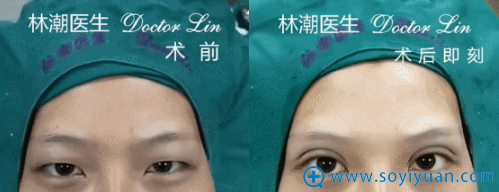 林潮医生第二位切开重睑+上睑祛脂真人案例 林潮医生第二位切开重睑+上睑祛脂真人案例