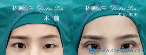 林潮医生第二位切开重睑+上睑祛脂(大小眼)真人案例 林潮医生第二位切开重睑+上睑祛脂(大小眼)真人案例