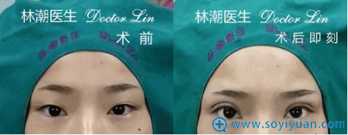 林潮医生第四位切开重睑+上睑祛脂真人案例 林潮医生第四位切开重睑+上睑祛脂真人案例