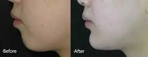 隆下巴前后对比照片 隆下巴前后对比照片