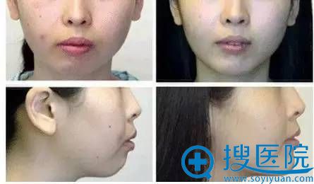 下巴短正面侧面都会显得嘴巴外凸 下巴短正面侧面都会显得嘴巴外凸