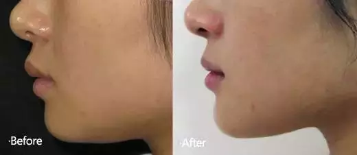 隆下巴手术前后的照片 隆下巴手术前后的照片