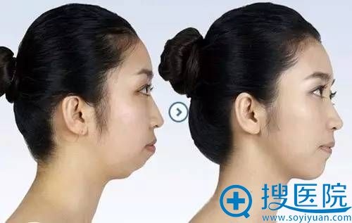 隆下巴 + 让你即刻拥有娇俏小V 隆下巴 + 让你即刻拥有娇俏小V