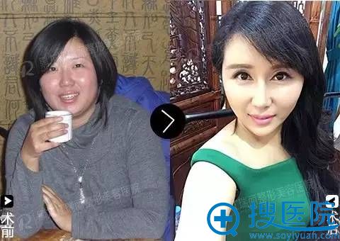 黑龙江瑞丽整形医院面部轮廓重塑 8项目蝶变真实案例 黑龙江瑞丽整形医院面部轮廓重塑 8项目蝶变真实案例