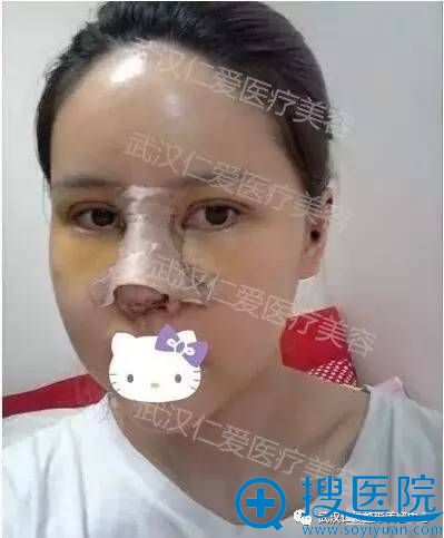 这是在仁爱做完双眼皮+隆鼻手术当天照的照片 这是在仁爱做完双眼皮+隆鼻手术当天照的照片