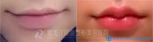 瑞丽玻尿酸注射M唇真实案例 瑞丽玻尿酸注射M唇真实案例