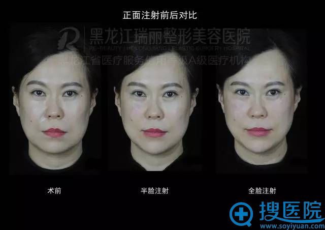 瑞丽玻尿酸填充塑形真实案例 瑞丽玻尿酸填充塑形真实案例