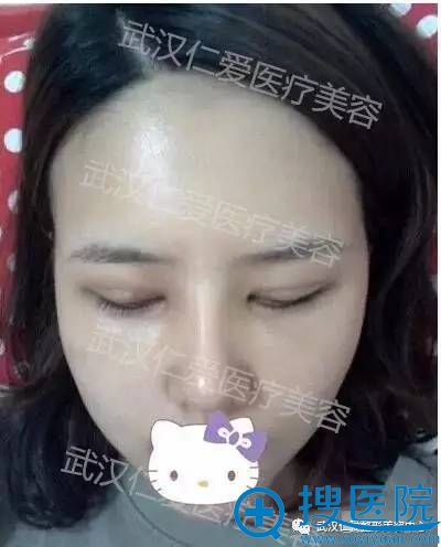 手术后第1个周觉得双眼皮线条有点儿粗呢 手术后第1个周觉得双眼皮线条有点儿粗呢