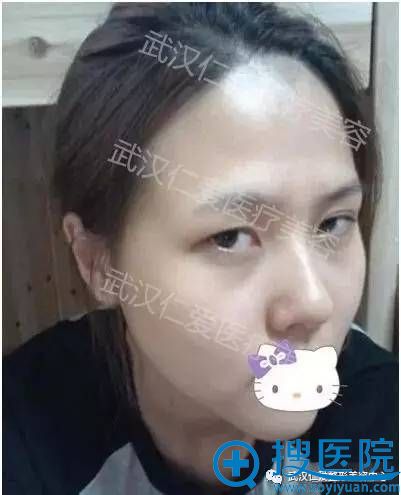�����人�ʰ�����ҽԺ���˺�ʽ�޺�˫��Ƥ+¡�� ���һ��˶���Ǯ