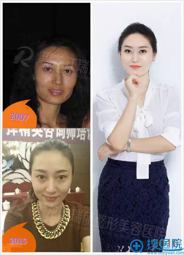 瑞丽美学设计师付丽9年间微整注射前后对比 瑞丽美学设计师付丽9年间微整注射前后对比