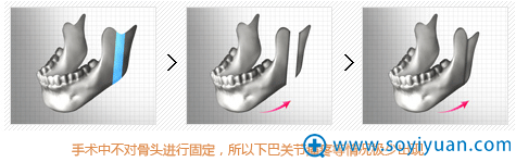 韩国原辰整形医院垂直截骨术手术方法3D图解 韩国原辰整形医院垂直截骨术手术方法3D图解