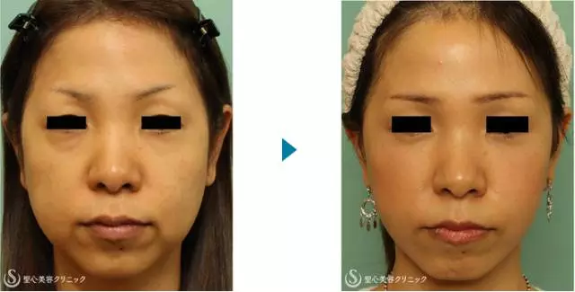 Ƭ�Զ���Ժ���沿������������������