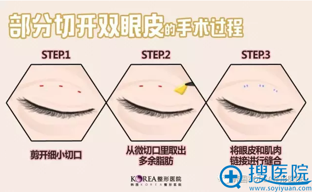 韩国KOREA整形医院双眼皮手术过程图 韩国KOREA整形医院双眼皮手术过程图