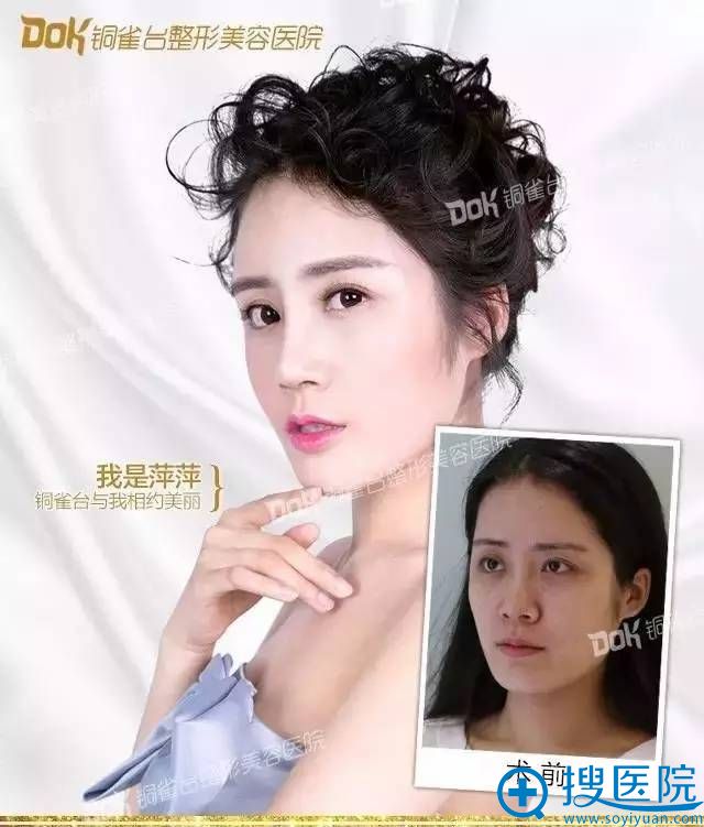 刚在重庆铜雀台整形美容医院做了隆鼻 看我恢复的自然吗