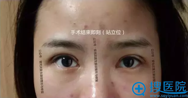 手术结束即刻站立位效果 手术结束即刻站立位效果