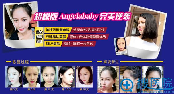 成都米兰柏羽整形案例效果图 成都米兰柏羽整形案例效果图