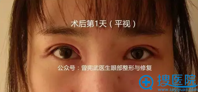 术后天眼部情况 术后天眼部情况