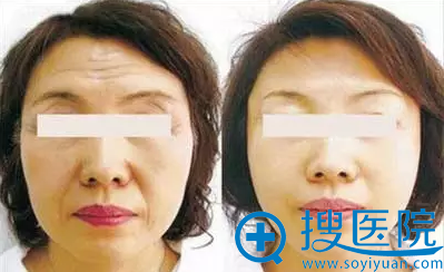 金宝玉去抬头纹手术案例 金宝玉去抬头纹手术案例