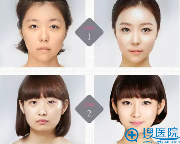 瑞士抗衰老大师马蒂亚斯·特伦普微整形手术案例 瑞士抗衰老大师马蒂亚斯·特伦普微整形手术案例