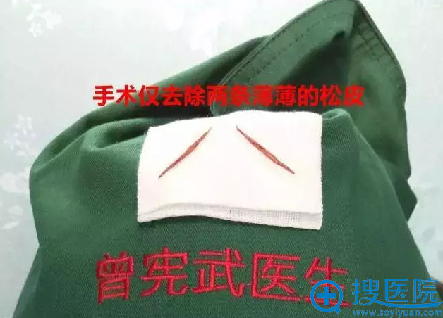 手术中去除的多余眼皮组织 手术中去除的多余眼皮组织