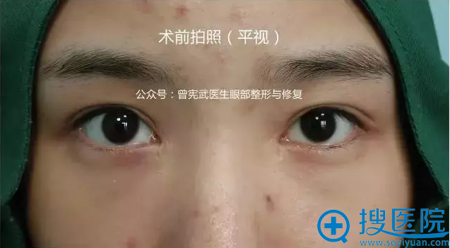术前平视拍照情况 术前平视拍照情况