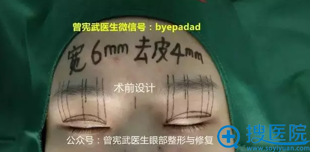 术前设计画线设计思路 术前设计画线设计思路