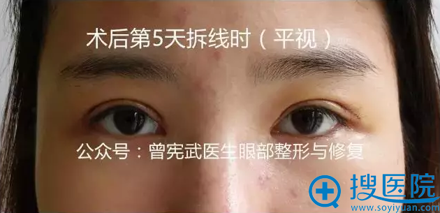 术后5天拆线时效果 术后5天拆线时效果