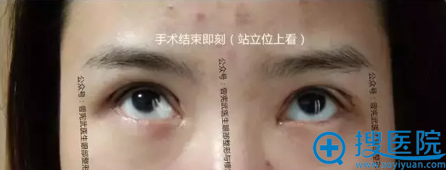 手术结束即刻站立位上看效果 手术结束即刻站立位上看效果