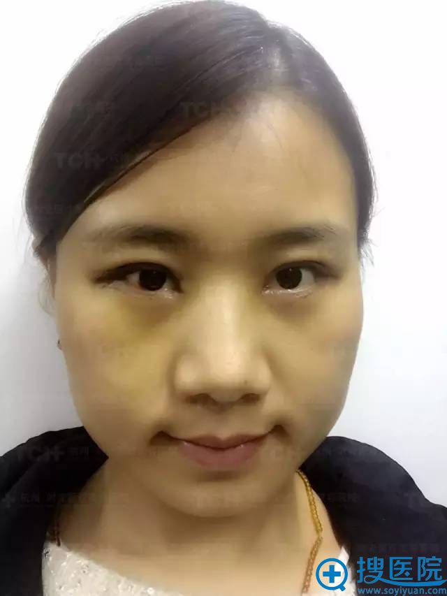 在杭州时光整形医院做的双眼皮修复日记 第二天有点肿 在杭州时光整形医院做的双眼皮修复日记 第二天有点肿