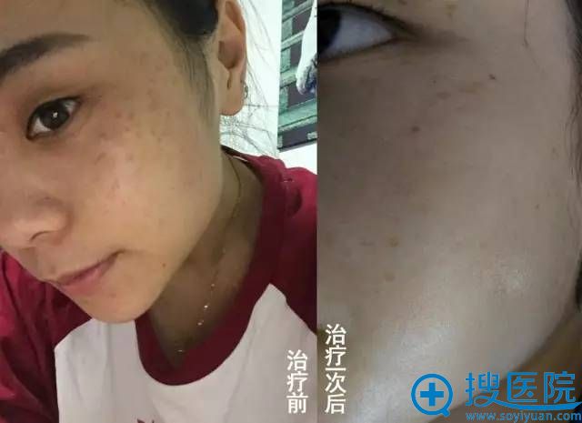 福州海峡整形医院一次祛斑嫩肤案例对比 福州海峡整形医院一次祛斑嫩肤案例对比
