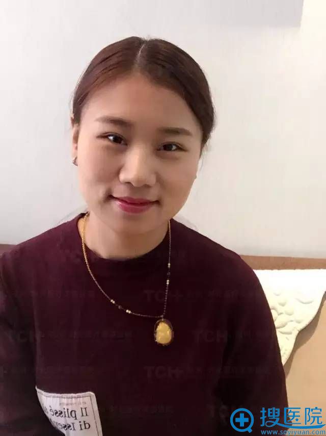 双眼皮修复日记28天 还打了哦 双眼皮修复日记28天 还打了哦