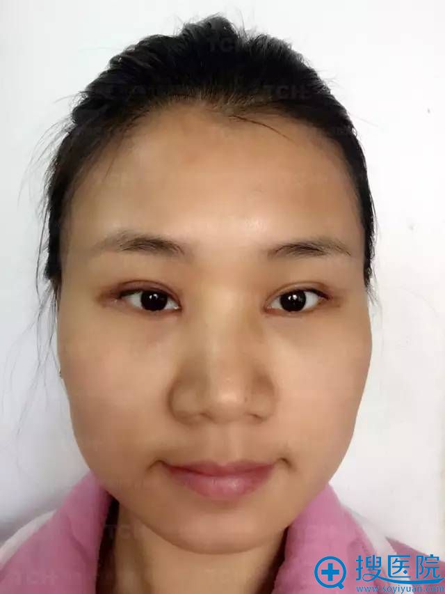 杭州时光整形医院双眼皮修复日记 第4天 杭州时光整形医院双眼皮修复日记 第4天