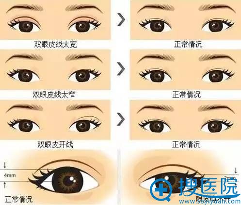 在杭州时光整形医院做的双眼皮修复日记 从眯眯眼到媚眼女神 在杭州时光整形医院做的双眼皮修复日记 从眯眯眼到媚眼女神