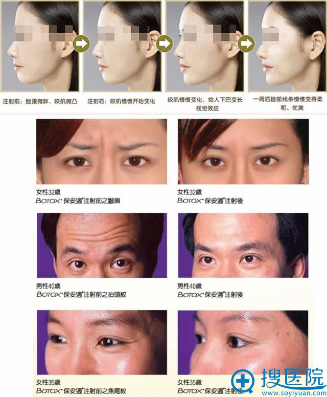 除皱瘦脸效果图 除皱瘦脸效果图