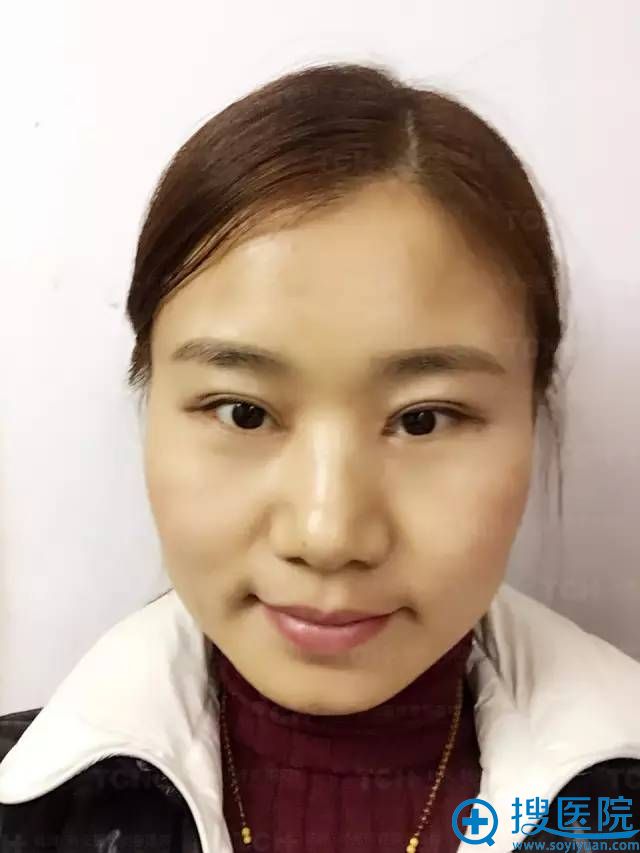 双眼皮修复20天了,已经很自然了 双眼皮修复20天了,已经很自然了