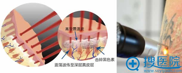 蜂巢皮秒镭射激光损伤效果 蜂巢皮秒镭射激光损伤效果